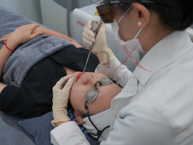 Laser 6d là dòng laser trẻ hóa hiện đại ngày nay 